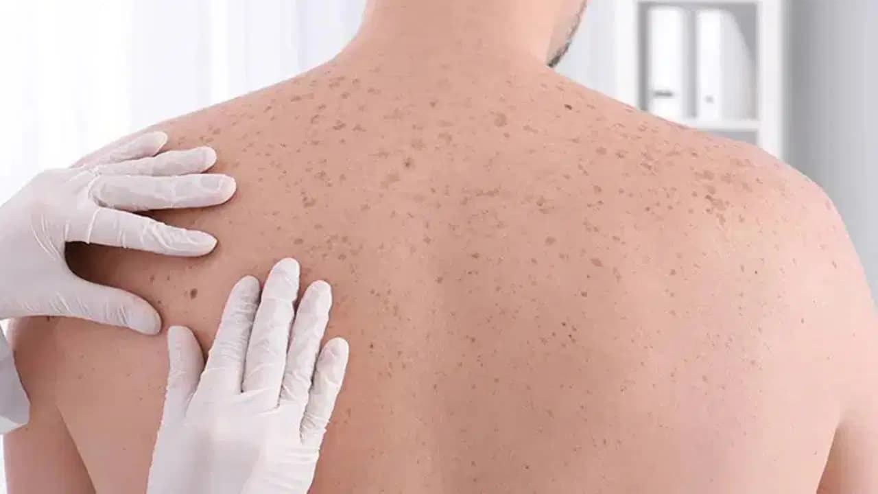 Onkoloji dünyasında tarihi başarı: Moderna'nın kişiselleştirilmiş mRNA kanser aşısı nüks riskini yüzde 42 düşürdü
