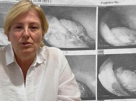 Safra kesesi ameliyatından 4 yıl sonra vücudunda unutulan gazlı bez ortaya çıktı